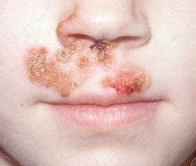 Az impetigo jellemző tünetei