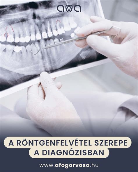 Röntgenfelvétel ólomköténnyel