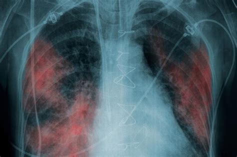 A tuberkulózis terjedésének ábrázolása