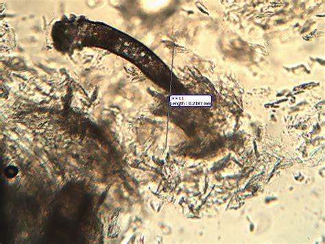 Bőrgyógyászati kezelés Demodex atka ellen