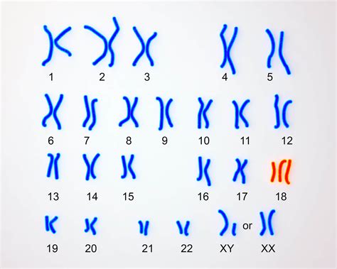 Kromoszóma diagram Down-szindrómával