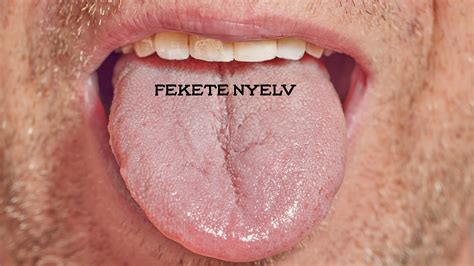 Szőrös nyelv szindróma