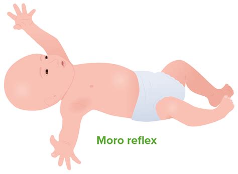 Moro reflex
