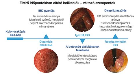 A kalprotektin szint alakulása IBD esetén