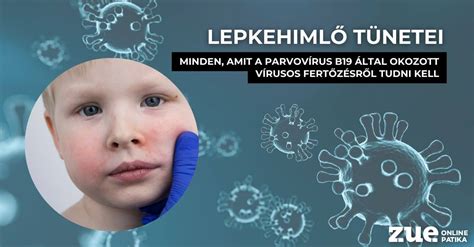 lepkehimlő (ötödik betegség) kiütései