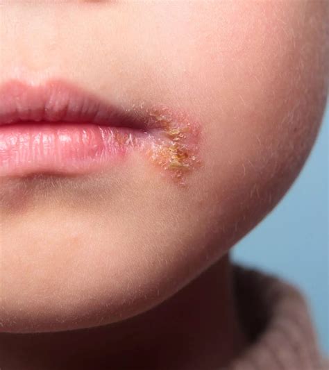 ótvár (impetigo)