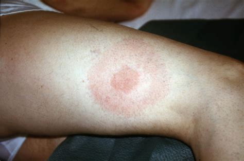 Lyme-kór erythema chronicum migrans