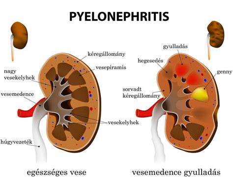 vesemedence gyulladás tünetei