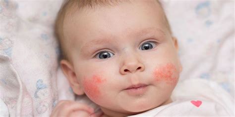 Allergiás reakciók egy csecsemő bőrén