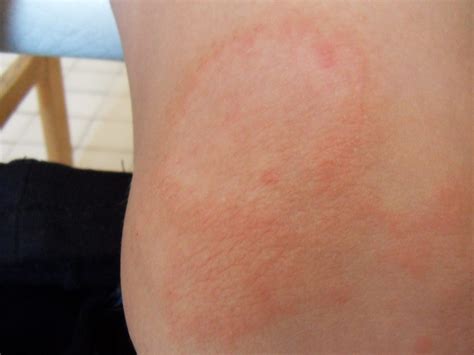 Tinea (kör alakú gombás bőrfertőzés) gyermek lábán