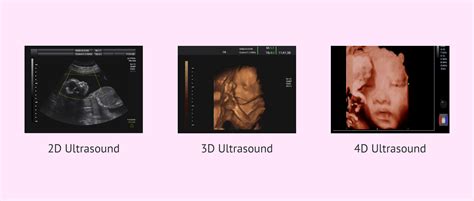 4D ultrahangfelvétel magzatról