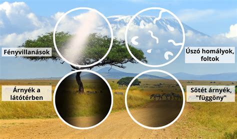 A retina szakadásának és leválásának illusztrációja