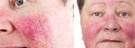 rosacea tünetei az arcon
