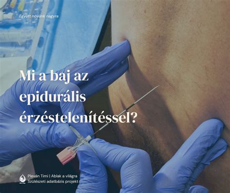 Epidurális érzéstelenítés a szülés során