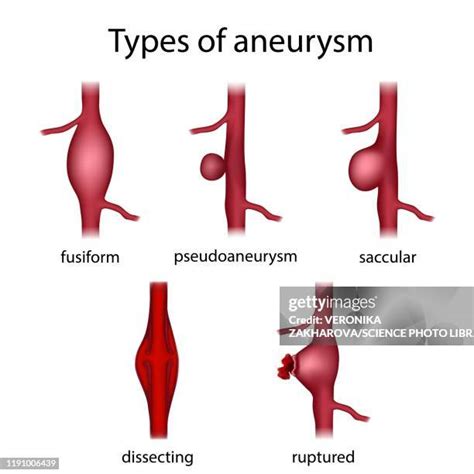 Különböző típusú aorta aneurizmák ábrázolása (fusiformis és saccularis)