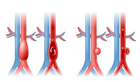 Infografika az aorta aneurizma leggyakoribb okairól és kockázati tényezőiről