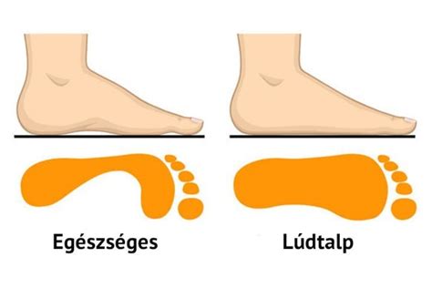Egészséges és deformált gyermeklábfejek összehasonlítása