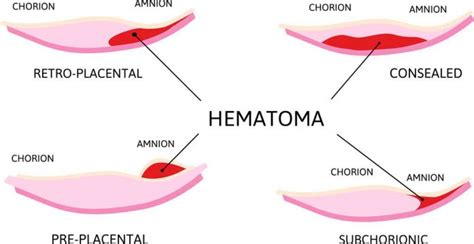 A subchorion hematóma elhelyezkedése a méhben