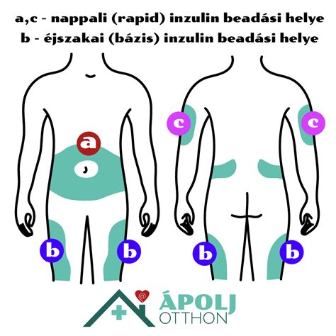 A Fraxiparine injekció beadási helyei