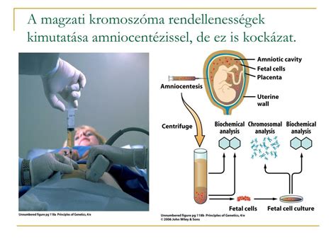Infografika a magzati kromoszóma vizsgálatokról