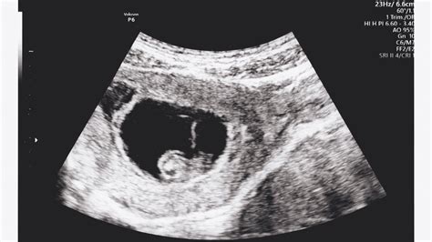 Magzatvízben úszó magzat