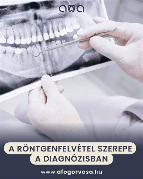 Röntgenfelvétel vállficamról