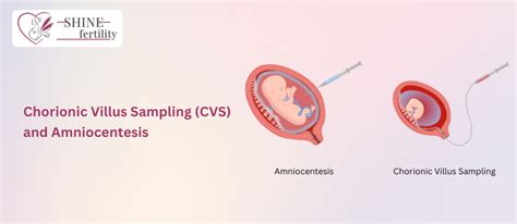 Amniocentesis és Chorionboholy-mintavétel (CVS) összehasonlítása