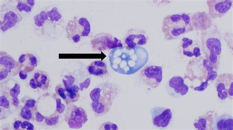 Térkép a Naegleria fowleri fertőzések globális eloszlásáról