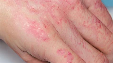 A dermatitis különböző típusai