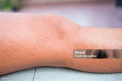 Allergiás reakciók, például csalánkiütés