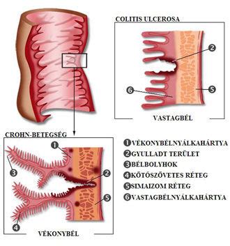 Crohn-betegség tünetei
