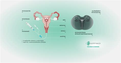 Petefészek stimuláció meddőségi kezelés során