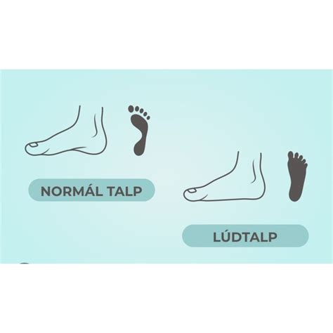 Lúdtalp a gyermekeknél