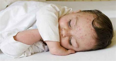 Csecsemő pelenkakiütés kezelése