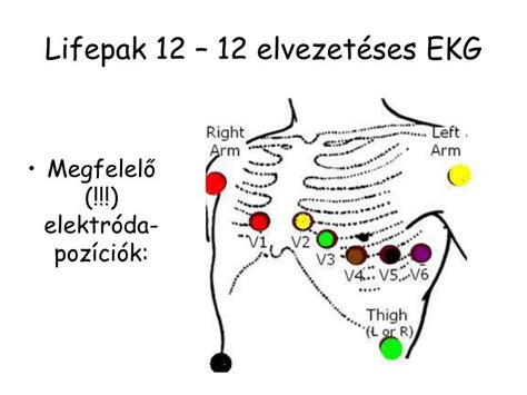 Újszülött EKG elektródák felhelyezése a mellkasra