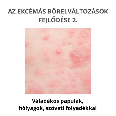 Ekcémás bőr felület