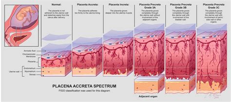 Orvosi csapat a placenta accreta kezelésében