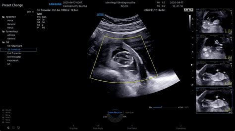 genetikai ultrahang a 12. hét körül