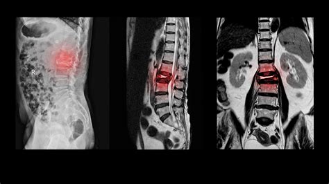 Gerincsérv MRI felvételen
