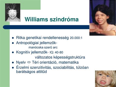 Williams-szindrómás arcvonások illusztrációja