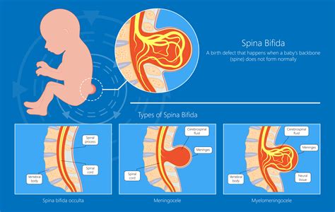 A spina bifida típusai