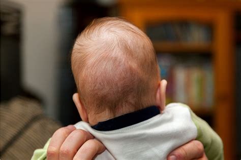 Craniosynostosis típusai és a koponya deformitásai