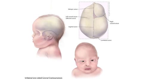 Koponyaformáló sisak használata craniosynostosis után