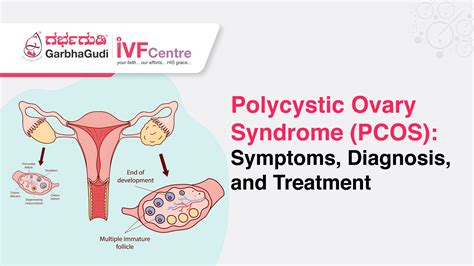 PCOS szindróma diagram