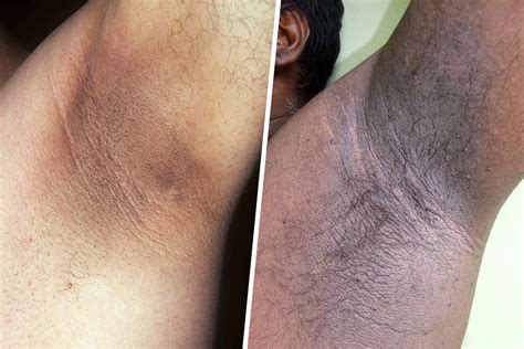 Acanthosis nigricans terhesség alatt