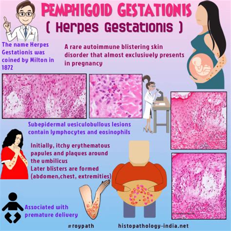 Herpes gestationis