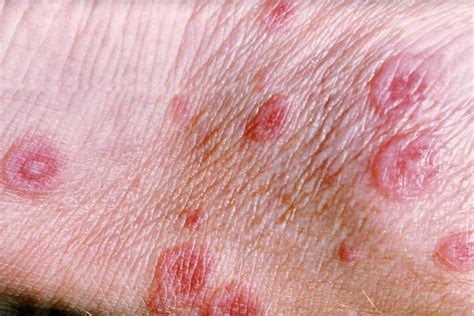 Erythema multiforme elváltozások