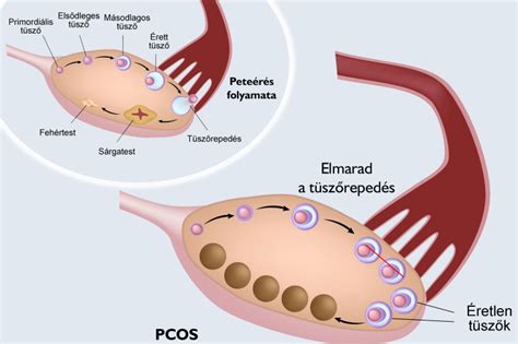 A petefészek ultrahangos képe PCOS esetén