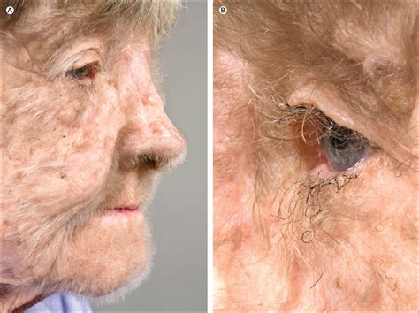 Ritka genetikai rendellenesség: Hypertrichosis lanuginosa