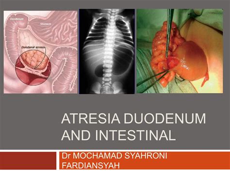 Duodenum atresia ultrahang képe: kettős hólyag jel